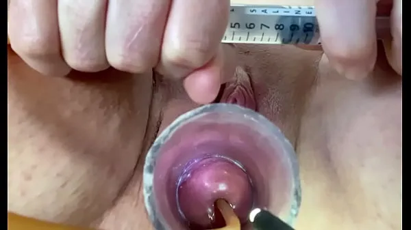 Best Extreme w inflation of catheter balloon in cervix best Videos