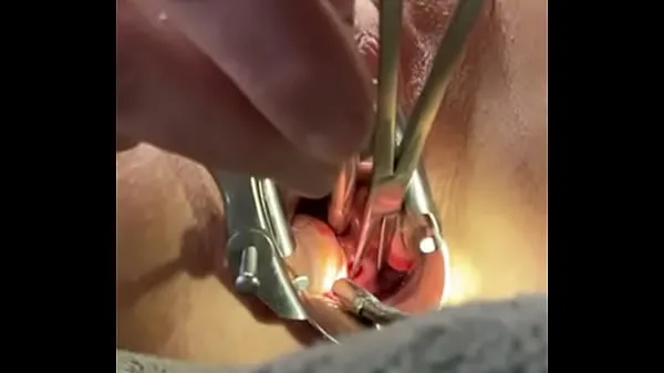 Best Holding cervix w tenaculum while 8mm dilator fucks uterus best Videos